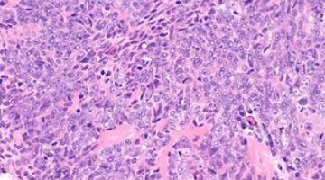 300px-Nasopharyngeal_carcinoma_-_alt_--_high_mag.jpg